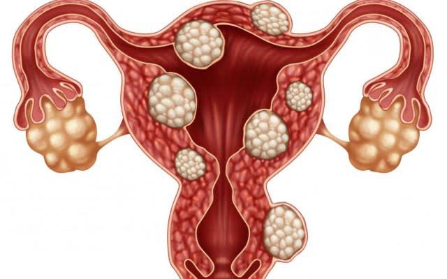 animación miomas uterinos